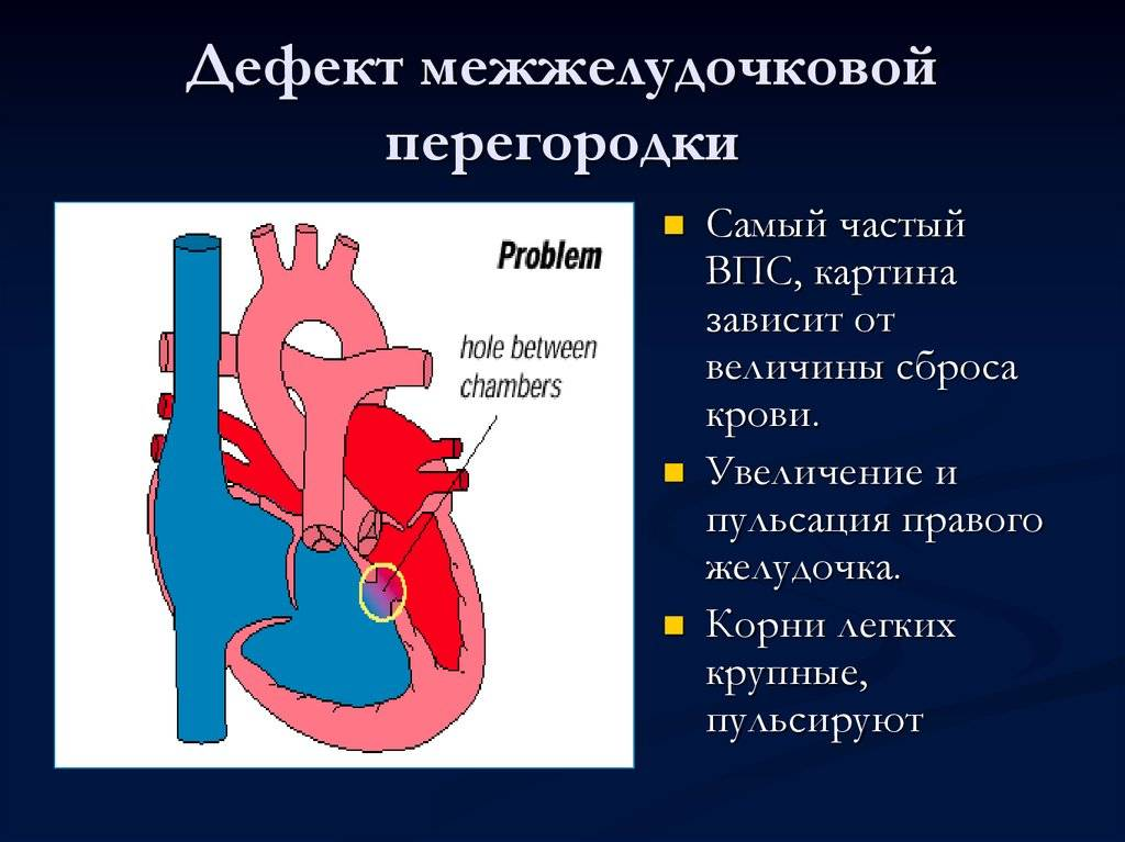 Причины гипертрофии правого предсердия