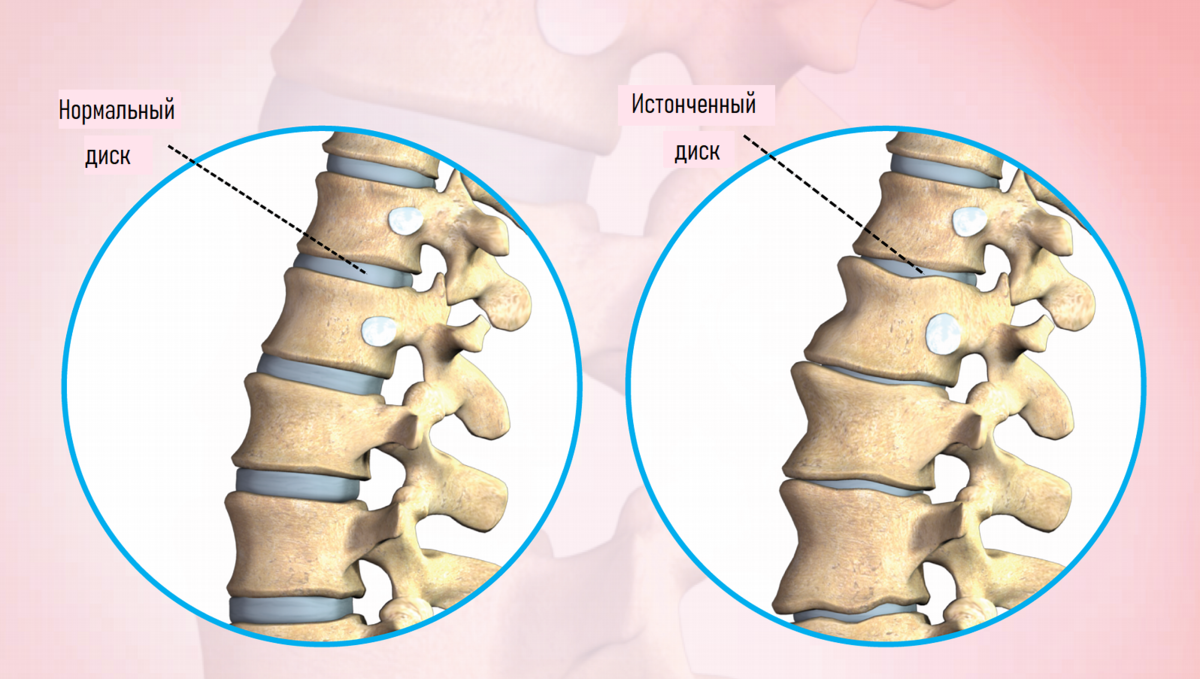 Деформирующий спондилез что это такое