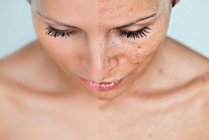 Черные точки на лице