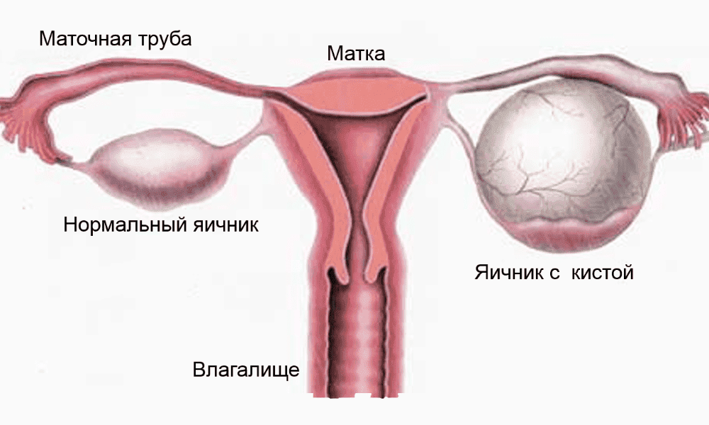 Болят яичники у женщины: причины, что делать - рекомендации врачей