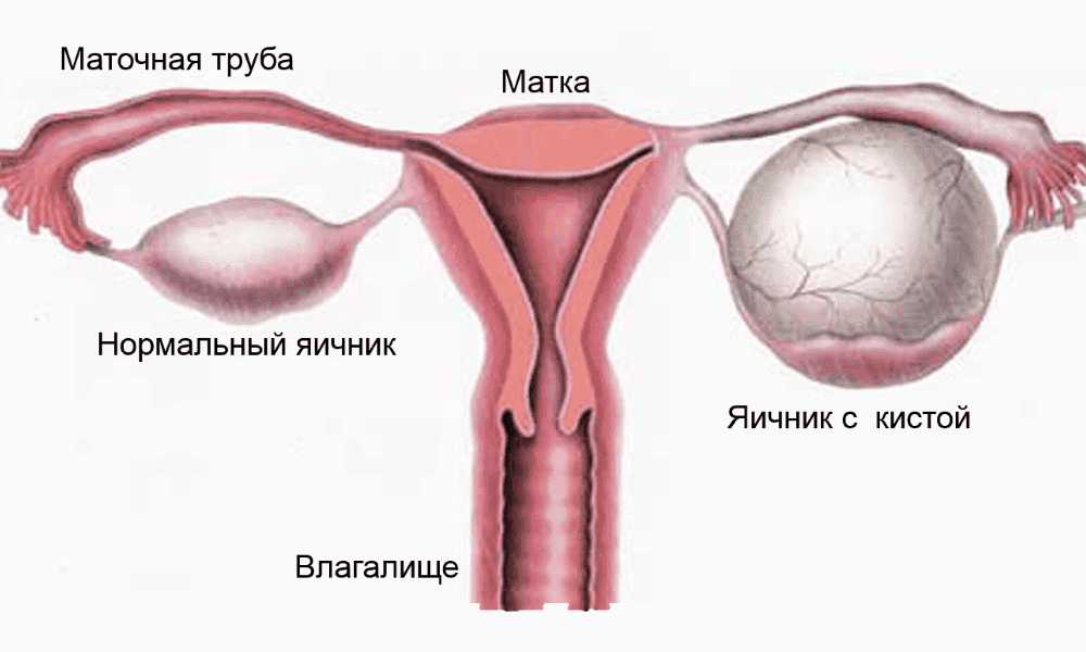 Почему болят яичники и что с этим делать