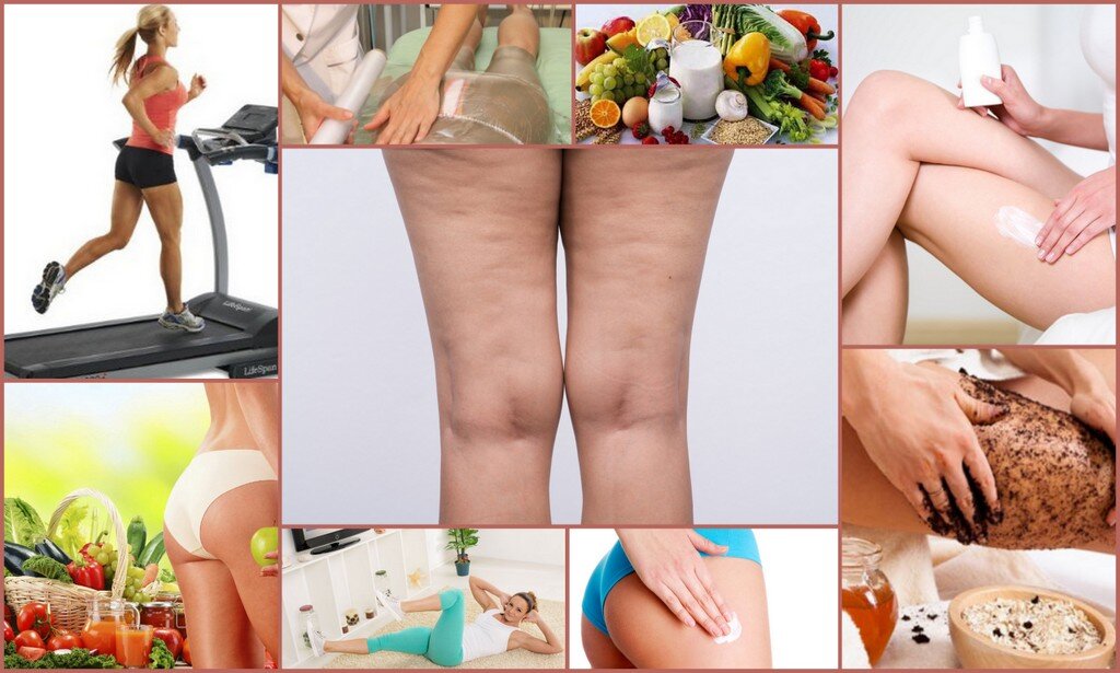 Антицеллюлитный массаж ног. Апельсиновая корка целлюлит. Как бороться с целлюлитом. Как бороться с целлюлитом. Как бороться с целлюлитом.