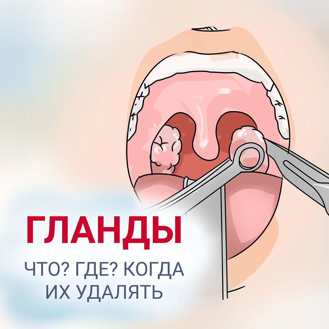 Гланды