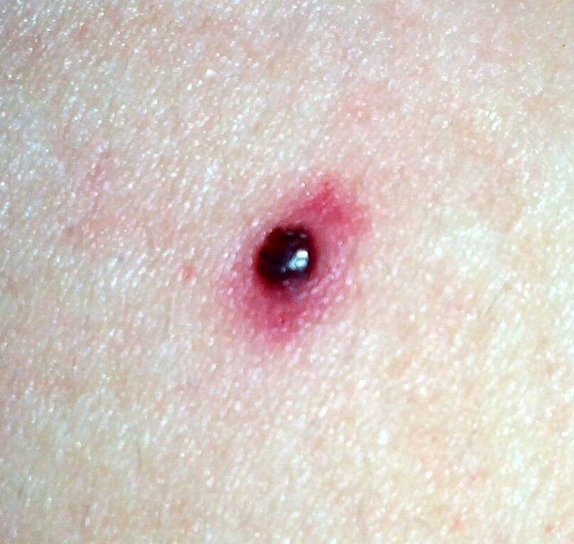 Травма родинки. Источник СМТ научный подход.