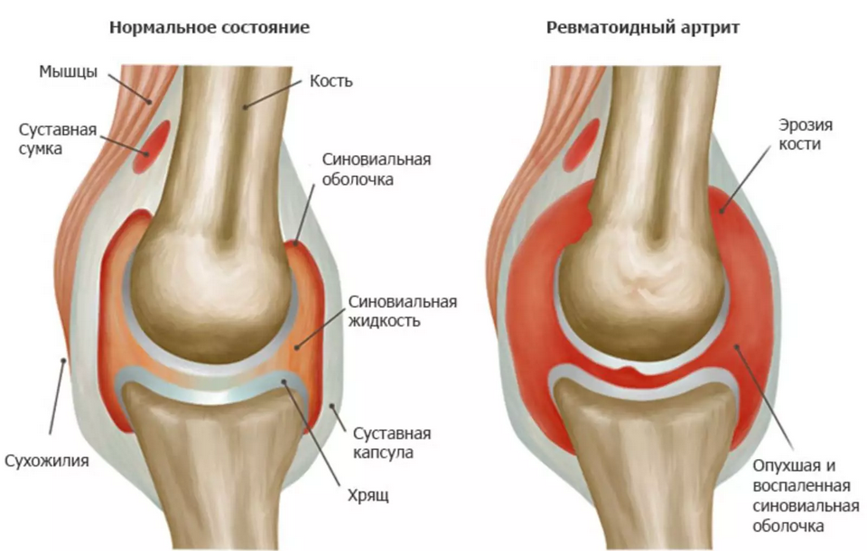 Коленный артрит лечение симптомы и лечение. Синовиальная мембрана коленного сустава. . Ревматоидный артрит, синовиальная оболочка сустава. Ревматоидный артрит и здоровый сустав. Суставы при ревматоидном артрите.