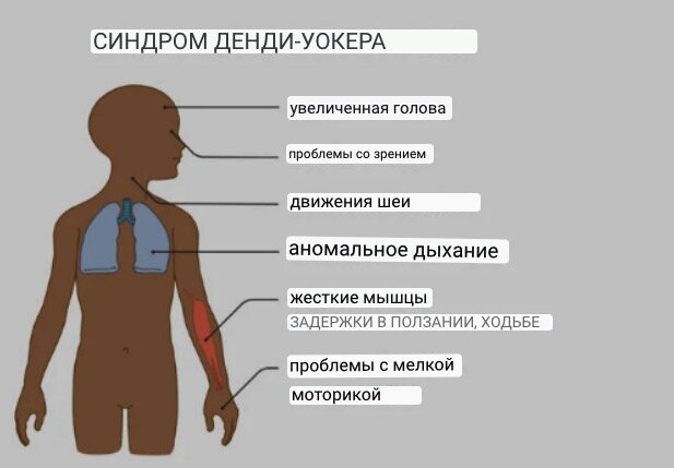 Синдром Денди-Уокера — это врожденное заболевание, при котором область головного мозга ребенка не развивается должным образом. Это зачастую приводит к нарушениям движения и равновесия.