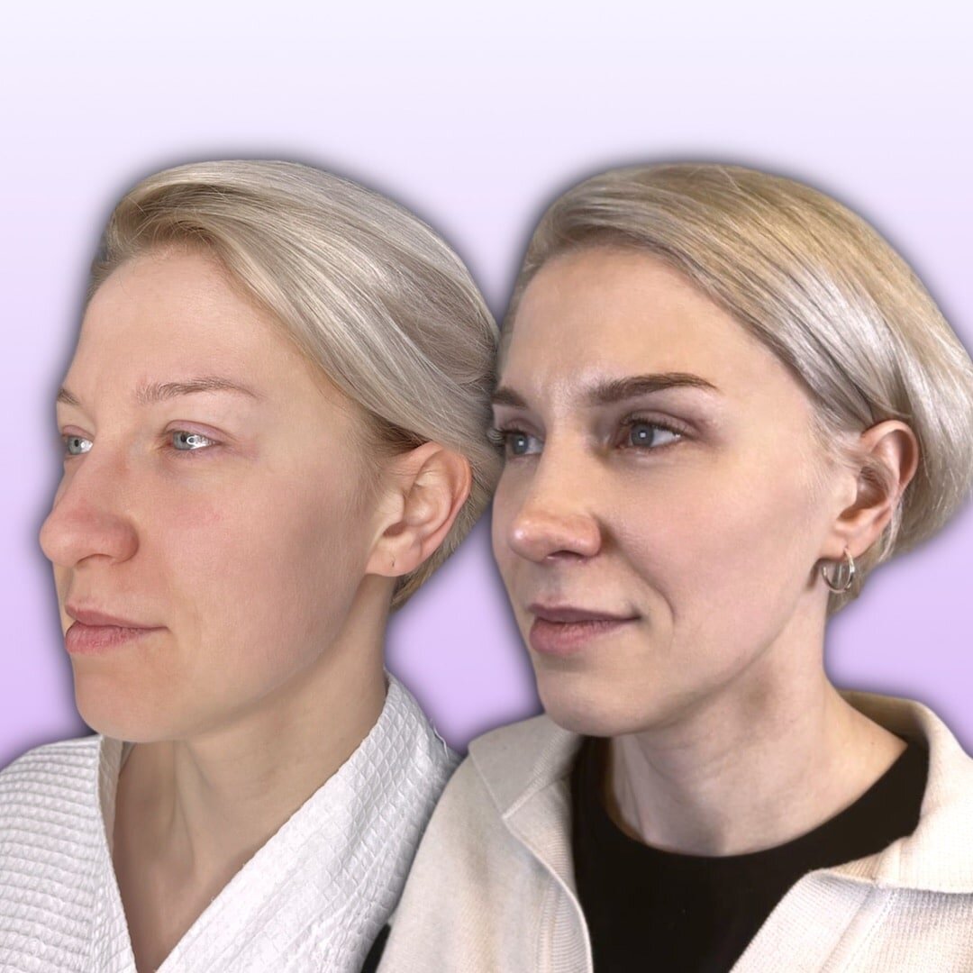 Результат ринопластики: до и после операции.