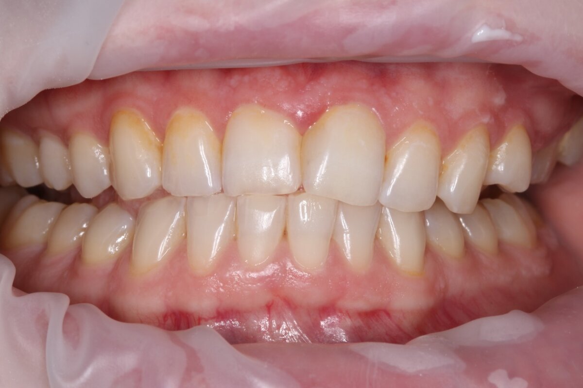 Отбеливание зубов zoom 4. Фото до и после. Мой опыт без боли