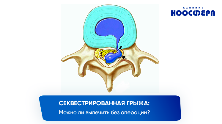 Секвестрированная грыжа лечение без операции. Секвестрированная грыжа межпозвоночных дисков. Секвестрированная экструзия. Секвестрированная грыжа мрт. Медианная секвестрированная грыжа.