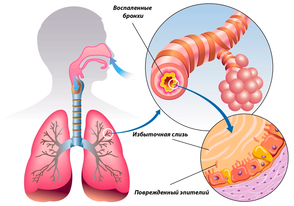 Бронхит — главное о заболевании | Evolutis Clinic | Дзен