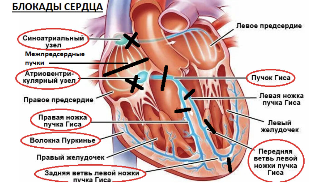 Блокады сердца у детей