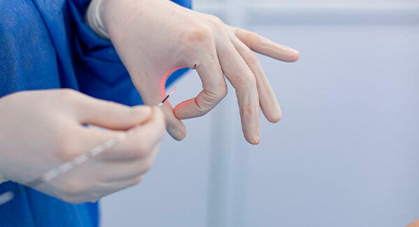 Источник - https://vascul.ru/articles/removal-of-spider-veins