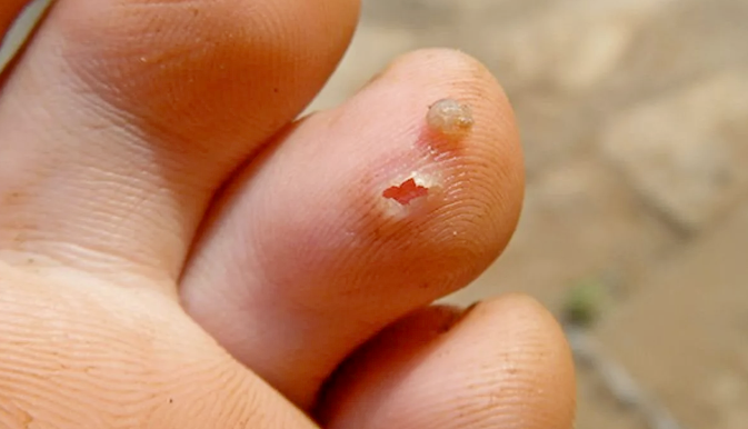 Место укуса и сама блоха