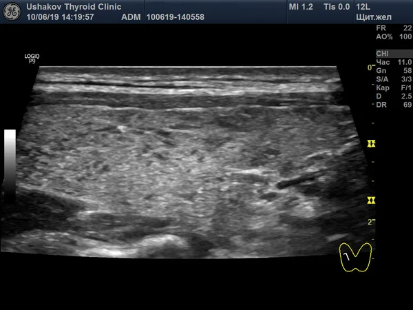 УЗИ щитовидной железы после лечения