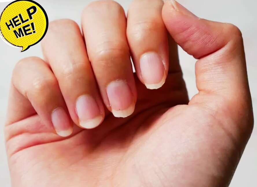 Почему сильно слоятся ногти и как их вылечить