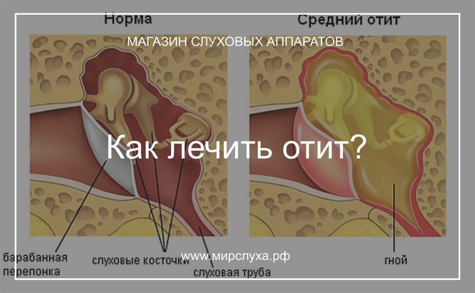 как лечить отит у ребенка 7 лет