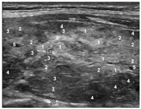 Designations: 1 - isoechogenicity, 2 - low hypoechoicity, 3 - moderate hypoechoicity, 4 - significant hypoechoicity, 5 - anechoicity, 8 low hyperechoicity, 7 - significant hyperechoicity (a - connective tissue septum, b - gland capsule from connective tissue from 2-3 layers).