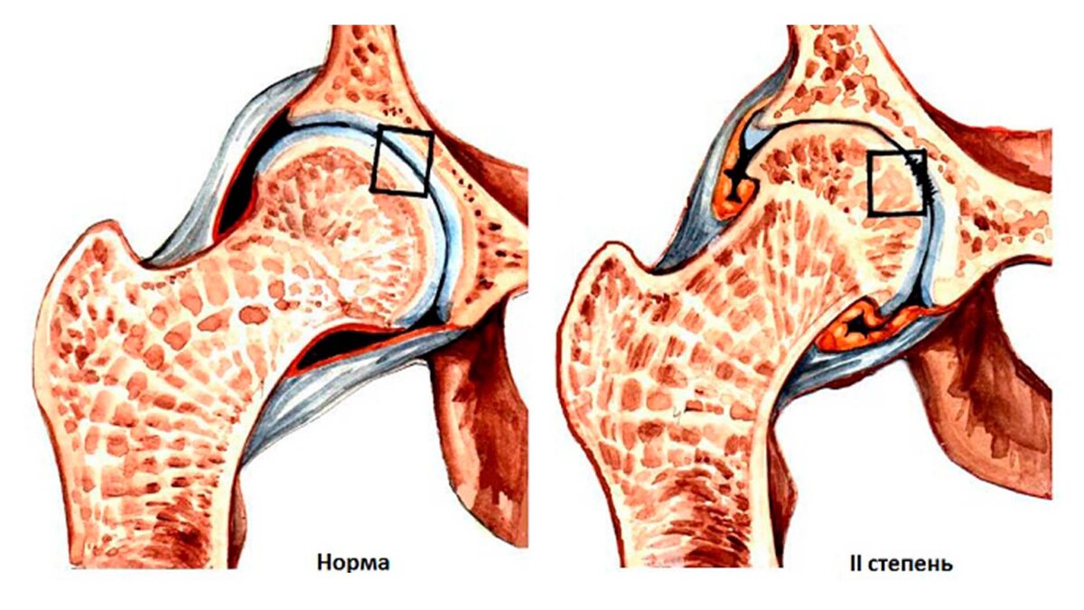 Коксартроз тазобедренного сустава 2 степени | Первая Медицинская Клиника |  Дзен
