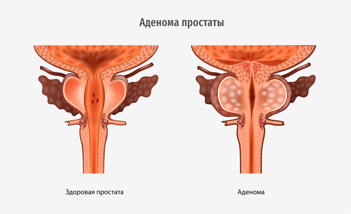 ПОГРАНИЧНЫЕ ПСИХИЧЕСКИЕ РАССТРОЙСТВА ПРИ ОПУХОЛЯХ ПРЕДСТАТЕЛЬНОЙ ЖЕЛЕЗЫ.