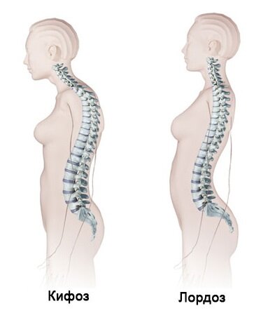 Слева представлен гиперкифоз, а справа гиперлордоз. В большинстве случаев он появляются примерно одинаково.
Источник: Яндекс.картинки