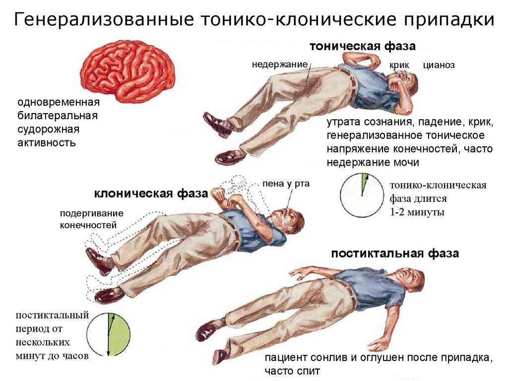 Стол при эпилепсии