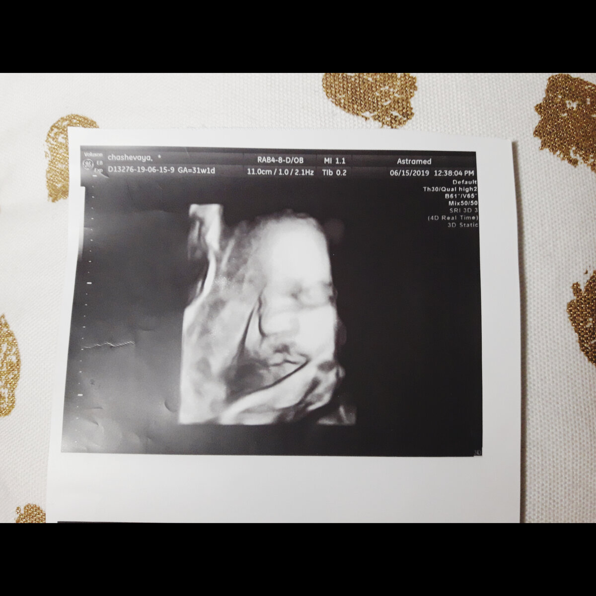 3 скрининг 3 беременность