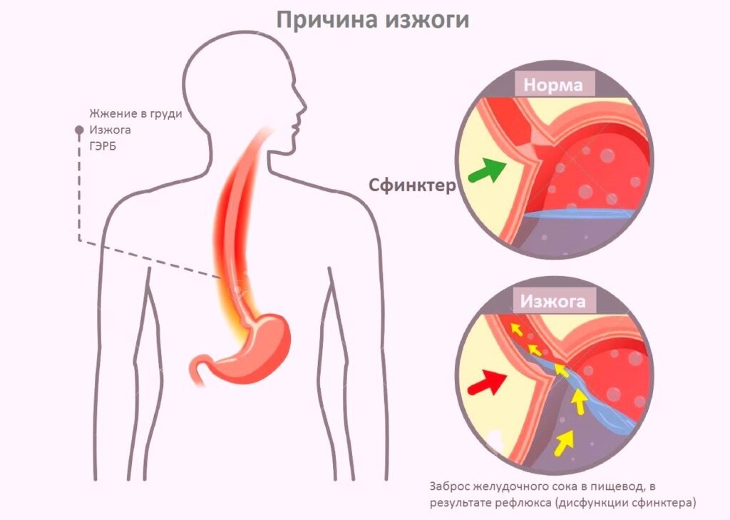 Изжога: причины и профилактика