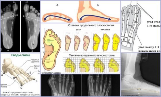 Плоскостопие 1-й степени