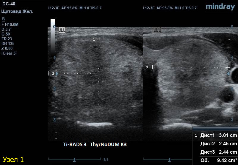 УЗИ щитовидной железы, Mindray DC-40