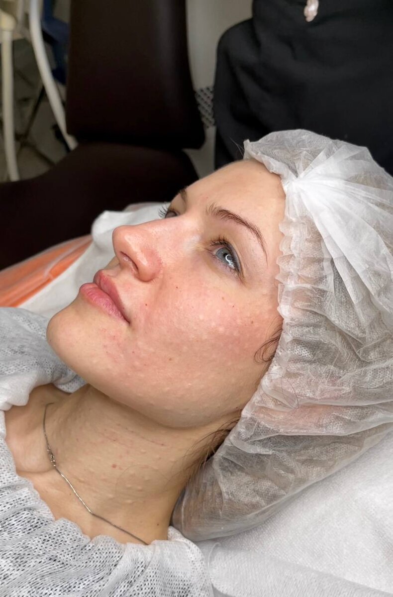 процедура Биоревитализация в Биоспаклиник