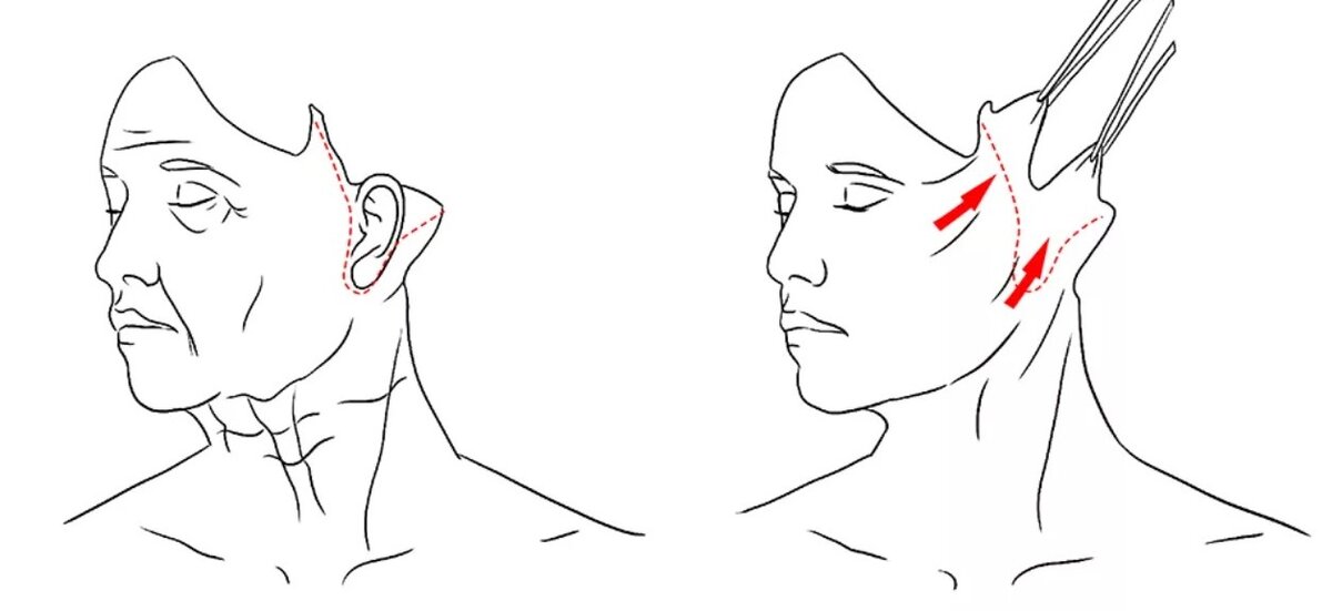Схема подтяжка лица. Смас лифтинг схема операции. Схема смас лифтинг лица. Схема проведения смас лифтинга. Смас лифтинг разрез кожи.