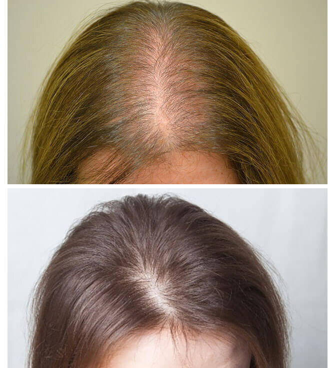 Выпадение волос у женщин: решение проблемы - Клиника «Доктор Волос»