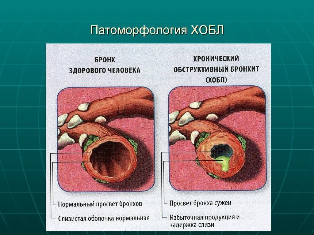 Хроническая обструктивная болезнь легких клиническая картина