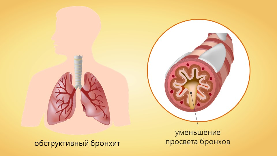 Подозрения на бронхит. Острый бронхообструктивный бронхит. Острый бронхит с синдромом бронхиальной обструкции. Обструктивный бронхиолит. Бронхит острый хронический обструктивный.