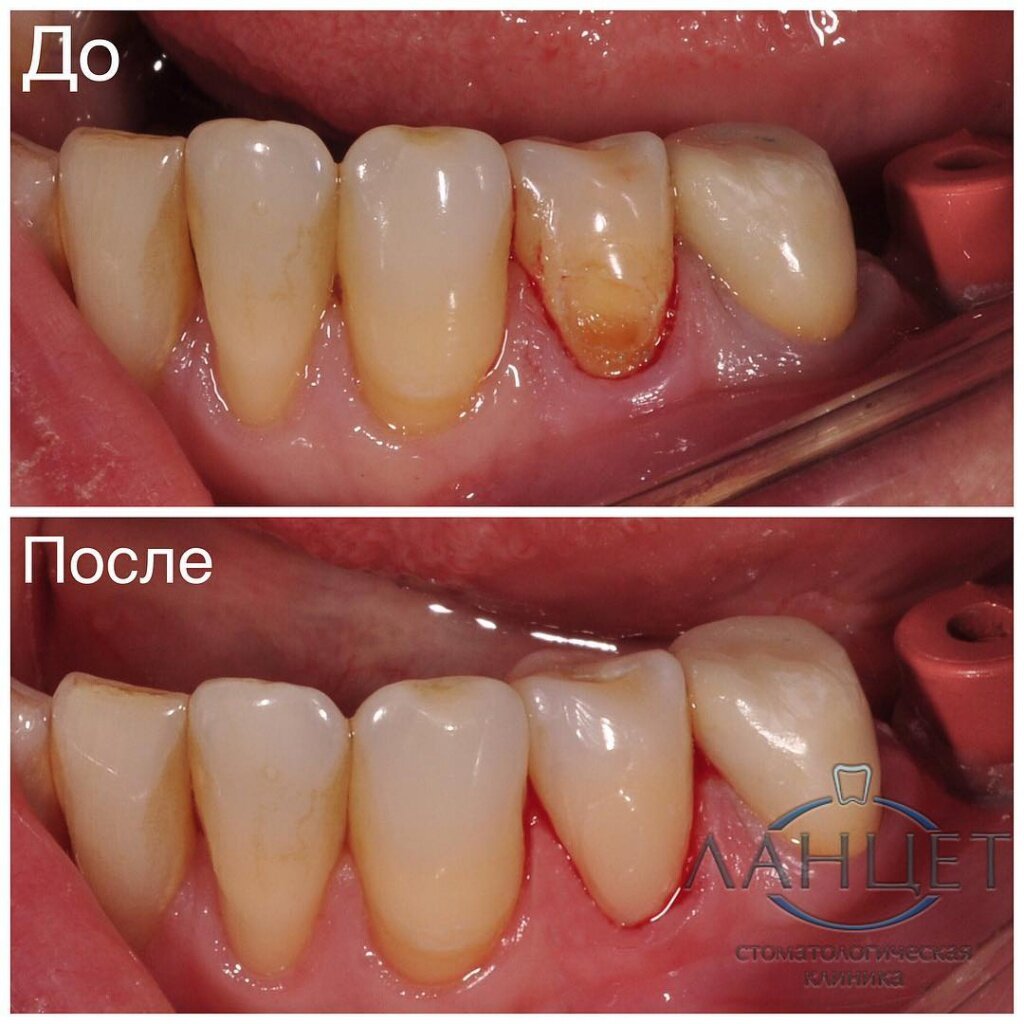 Для объективной оценки результата мы делаем снимки "до и после". 
Вкладка керамическая на 34 зуб
Врач Ланцет Д.Г. 
