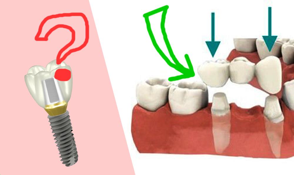 Мостовидный протез (мост) или имплантат?
