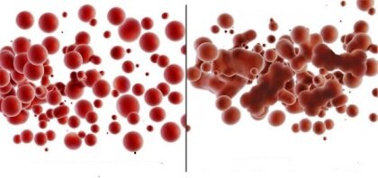 слева: кровь под микроскопом трезвого человека
справа : кровь под микроскопом пьяного человека