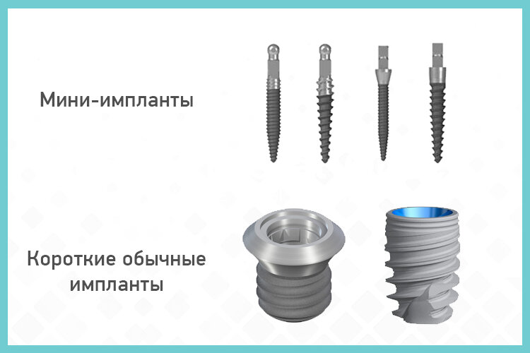 дентальный имплантат mis m4. разница в имплантах. базальные имплантаты biomed. имплантаты с агрессивной резьбой. имплантация и протезирование.