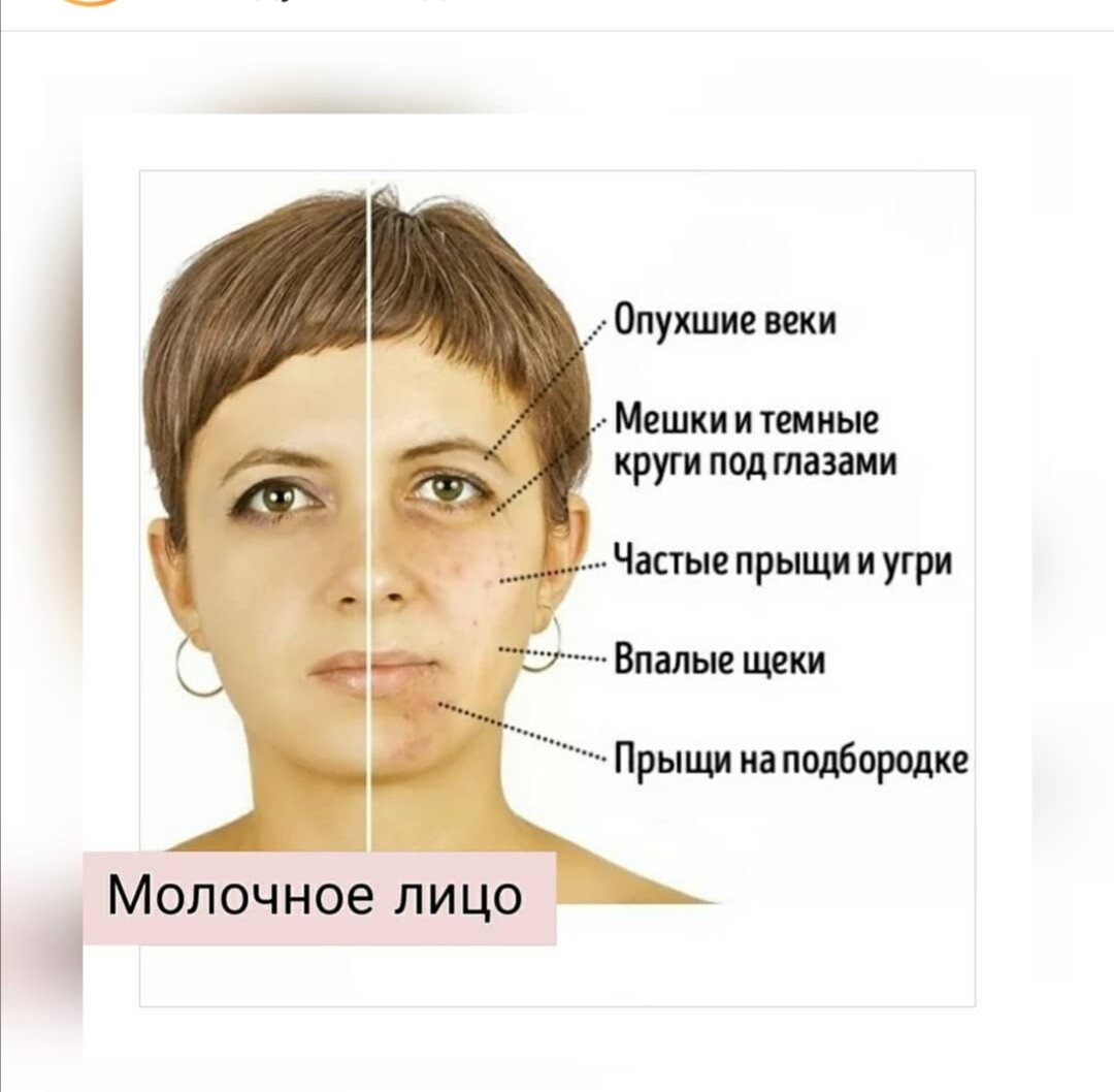 Вот такое лицо, из Инстаграмма!, и такое было и у меня. Ужасно просто! Щеки мало того что были впалыми, они ещё были багрово-фиолетовыми от прыщей