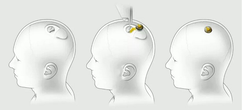 Установка Neuralink