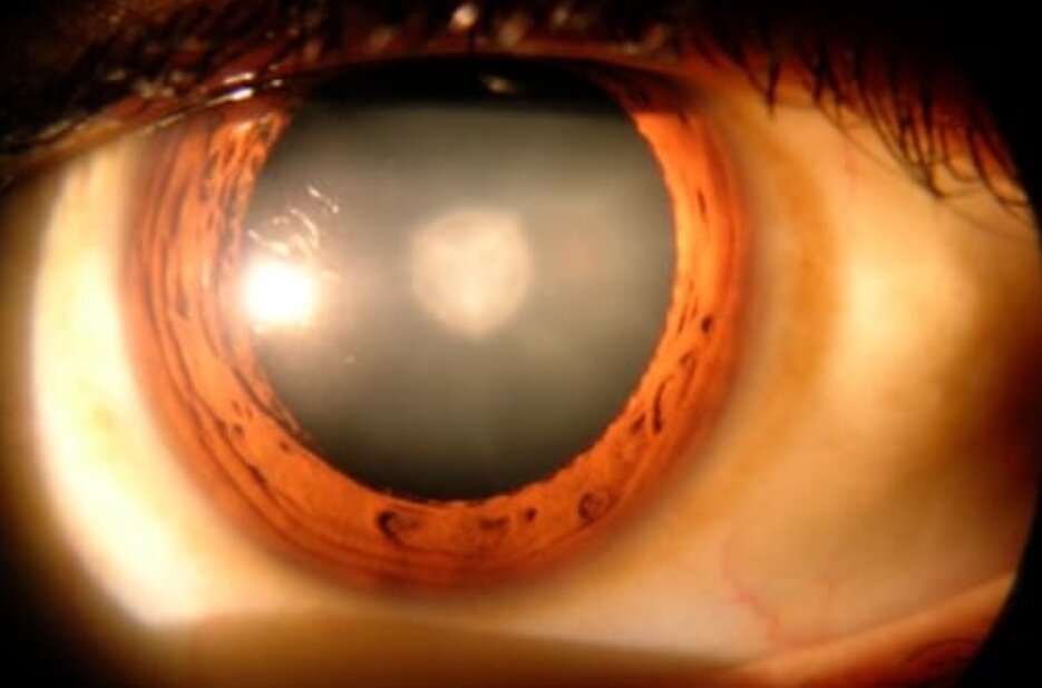 Примерно так выглядит катаракта - патологическое состояние, связанное с помутнением хрусталика глаза. Существует много причин, способствующих развитию катаракты