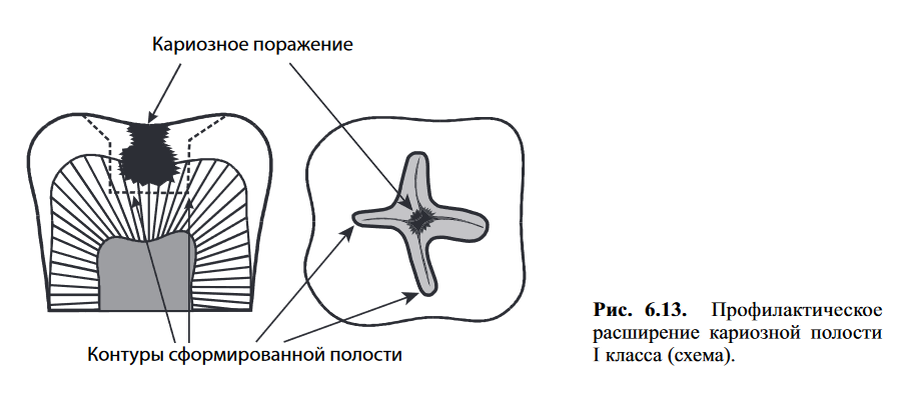Профилактическое расширение