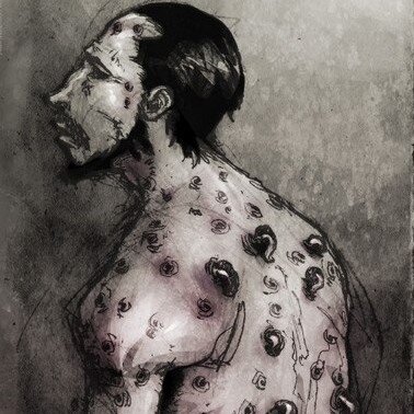 Не стану травмировать реальными фото. Иллюстрация достаточна наглядна.