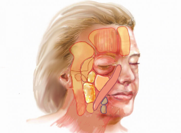 Жировые пакеты на лице фото анатомия