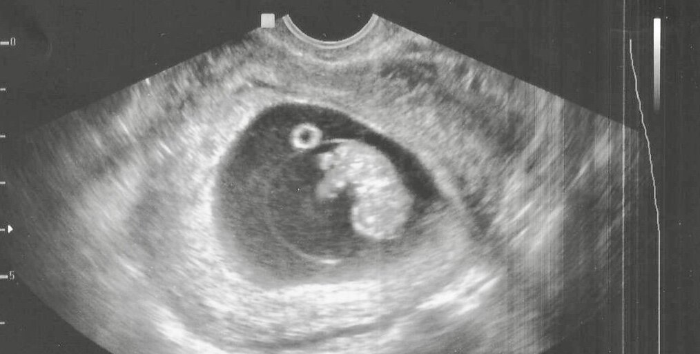 УЗИ при беременности раннего срока