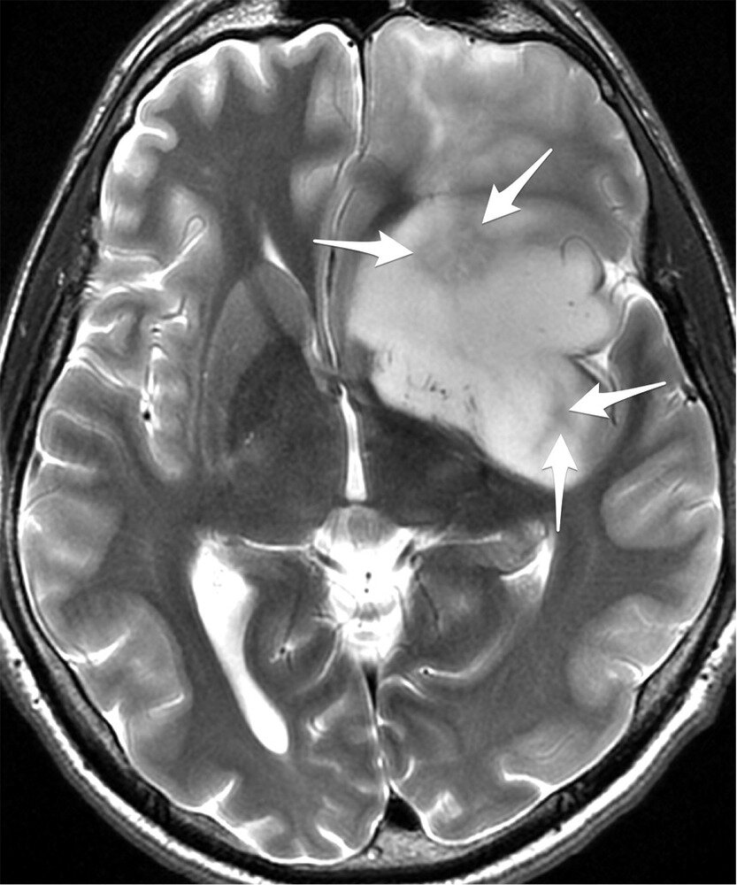Глиома. https://www.mediasphera.ru/system/photos/files/000/036/956/original/voprosy_neirokhirurgii_2015_06_01_ris2.jpg?1464701419