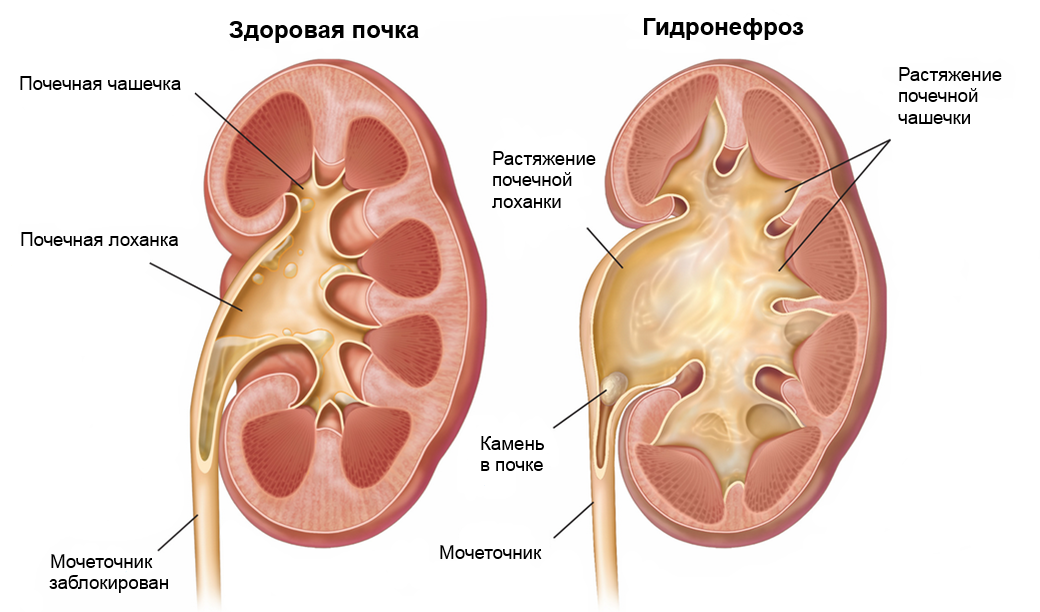 Камни в почках