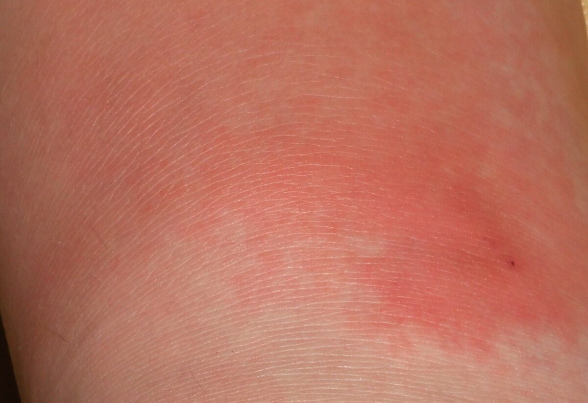 Рожистое воспаление на руке