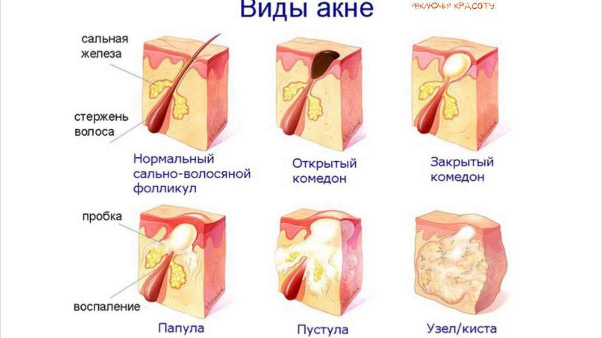 Виды акне.