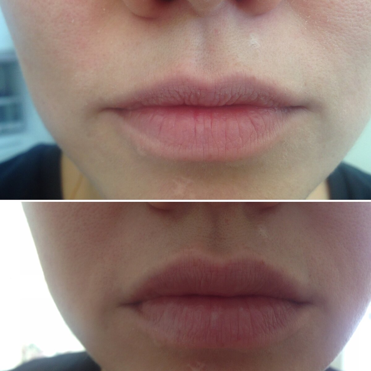 1 мл препарата Teosyal KISS 